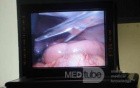 Gastric Ulcerated Adenocarcinoma of the Pre-pyloric Antrum (13 of 28)