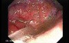 Severe case of Ischemic Colitis (8 of 19)