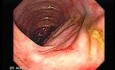 Consecutive colonoscopy with dilation was carried out (9 of 15)