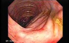 Consecutive colonoscopy with dilation was carried out (9 of 15)