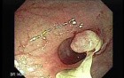 Polyp Inside Of A Diverticulum (7 of 12)