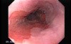 Barrett Esophagus - endoscopic view  (8 of 9)