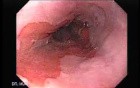 Barrett Esophagus - endoscopic view  (8 of 9)