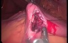 SILS Gastric Bypass