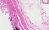 Atherosclerosis - Histopathology - Aorta