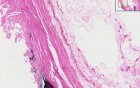 Atherosclerosis - Histopathology - Aorta