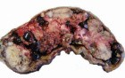 Gallbladder Adenocarcinoma and litiasis (2 of 13)