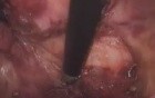 Laparoscopic Abdominoperineal Resection (Colorectal Surgery) 