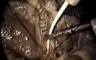Laparoscopic Gallbladder Surgery