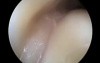 Arthroscopy Of The Scapulohumeral Joint Using Air Insufflation