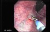 Rectal Dieulafoy’s Lesion (2 of 4)