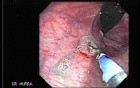 Rectal Dieulafoy’s Lesion (2 of 4)