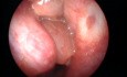 Multiple Nasal Polyps