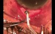 Neovascular glaucoma surgery