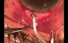Neovascular glaucoma surgery