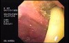 Partial Dehiscence of Suturing with Gastro-cutaneous Fistula (3 of 4)