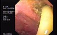Partial Dehiscence of Suturing with Gastro-cutaneous Fistula (3 of 4)
