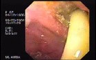 Partial Dehiscence of Suturing with Gastro-cutaneous Fistula (3 of 4)