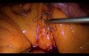 Laparoscopic Gastric Bypass - Part 5
