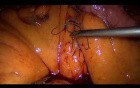 Laparoscopic Gastric Bypass - Part 5