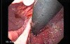 Adenocarcinoma of the Gastroesophageal Junction - Two Hernias