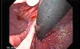 Adenocarcinoma of the Gastroesophageal Junction - Two Hernias
