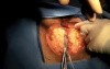 Abdominoperineal Resection with Sacrectomy - with Use of Robotic. Obese Male Patient