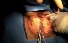 Abdominoperineal Resection with Sacrectomy - with Use of Robotic. Obese Male Patient
