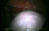 Total Excision of the Uterus - Laparoscopic Method