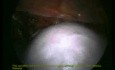 Total Excision of the Uterus - Laparoscopic Method