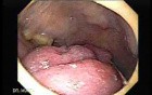 Squamous cell carcinoma of the tongue - exophytic mass(2 of 3)