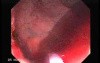 Tubulo - Villous Rectal Adenoma - Endoscopy (15 of 35)