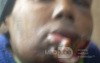 Lip Cancer