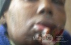 Lip Cancer