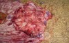 Adenocarcinoma of the cardias and gastric fundus with signet-ring cells (12 of 25)