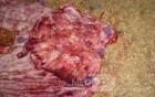 Adenocarcinoma of the cardias and gastric fundus with signet-ring cells (12 of 25)