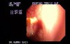 Small Traqueo-Esophageal Fistula - 90 Years-Old Male