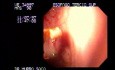 Small Traqueo-Esophageal Fistula - 90 Years-Old Male