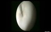 TVL Ovarian Drilling 