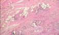 Early Gastric Cancer (18 of 21)