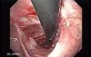 Colonic Interposition for Esophageal Substitution (11 of 11)