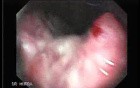 Gastric Adenocarcinoma With Varices - Endoscopy (1 of 8)