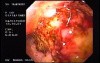 Adenocarcinoma of the Gastric Incisure