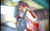 Sinus Lifting (1/2)