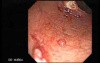 Stalked Polyp - Polypectomy (6 of 6)