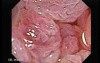 Tubulo-Villous Adenoma (5 of 6)