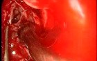 Frontal Sinus Threpination