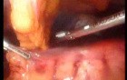 Gastrointestinal Stromal Tumor - GIST (18 of 65)