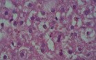 Hepatitis C
