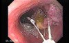 Colonoscopic Polypectomy (15 of 29)